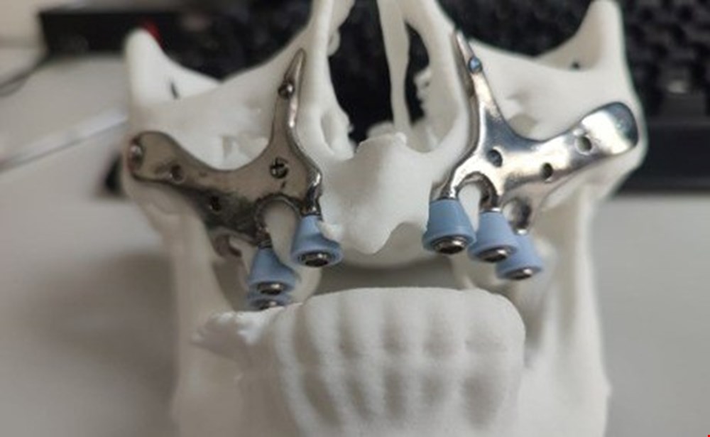 Changing Faces, Changing Lives: Custom 3D-Printed Medical Implants