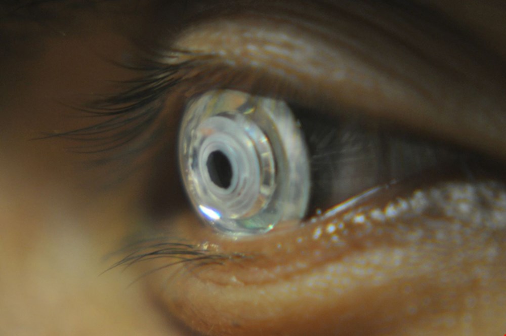 Zoomable contact lens could in future help visually impaired