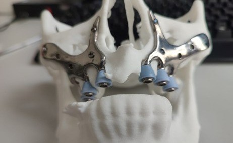 Changing Faces, Changing Lives: Custom 3D-Printed Medical Implants